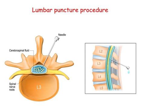 Why Does My Back Hurt Months After Lumbar Puncture
