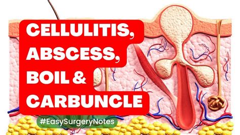 Cellulitis Abscess Boil And Carbuncle Easysurgerynotes Youtube
