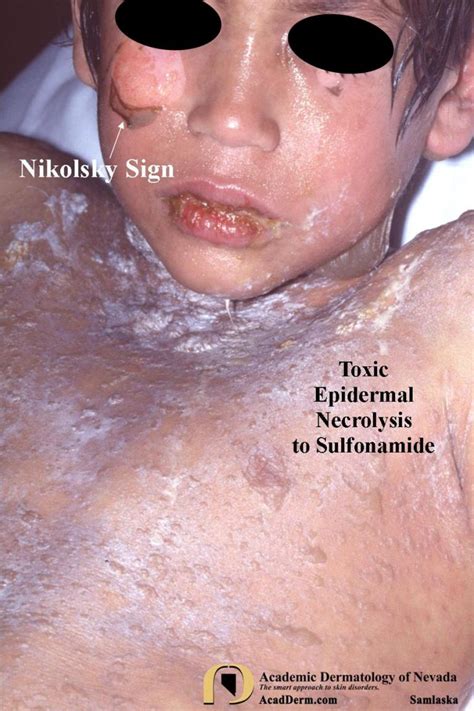 Drug Eruptions Toxic Epidermal Necrolysis TEN Academic Dermatology