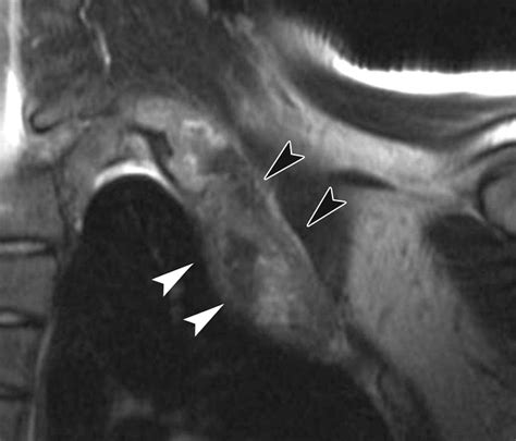 Imaging Of Primary Chest Wall Tumors With Radiologic Pathologic