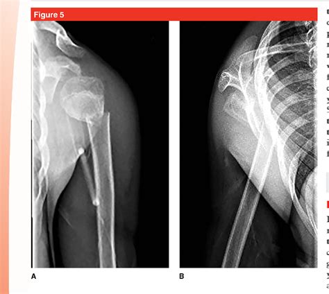 Evaluation And Management Of Pediatric Proximal Humerus Fractures My