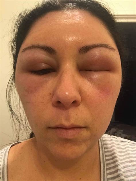 Woman's Face Balloons After Severe Allergic Reaction To ...