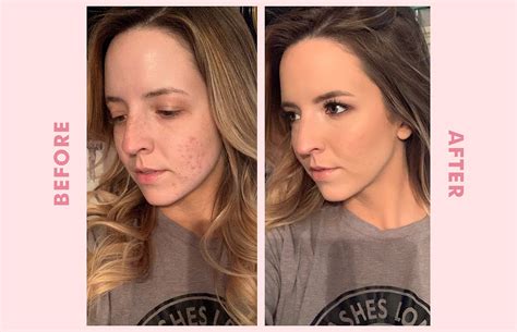 How To Cover Up Back Acne Scars With Makeup Makeupview Co