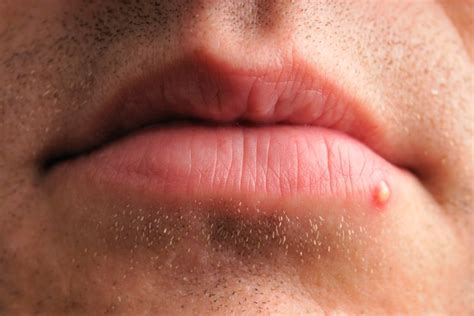 Herpes Blister On Upper Lip