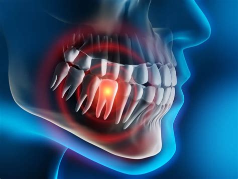 When To See A Dentist About Wisdom Tooth Pain Ora Dental