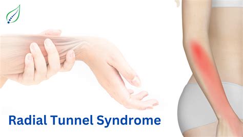 Radial Tunnel Syndrome Symptoms Causes And Treatments Best Back