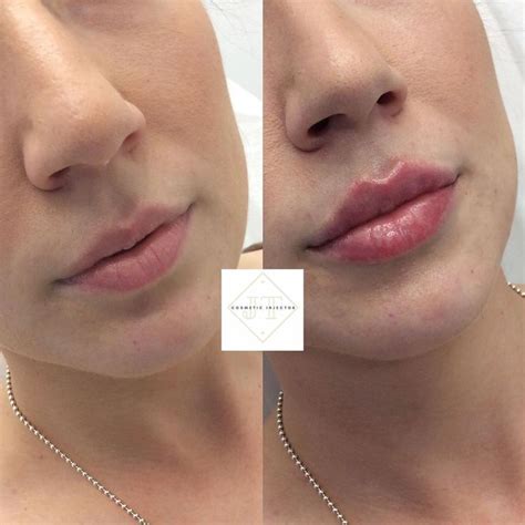First 1ml Of Lip Filler Mainly For Hydration For This Client Photo On