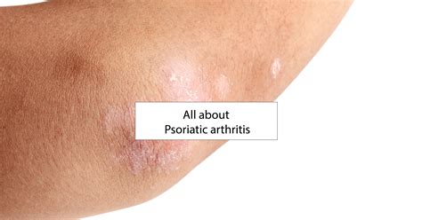 Psoriatic Arthritis Elbow