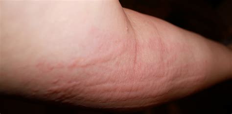 Random Itchiness And Rash Allergy Cold Blood Pressure Swelling