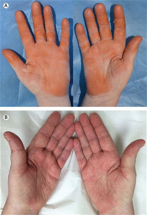 T Dm1 Related Carotenoderma And Hand Foot Syndrome The Lancet