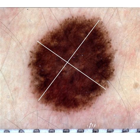Skin Lesions With A Regular Borders B Irregular Borders Download
