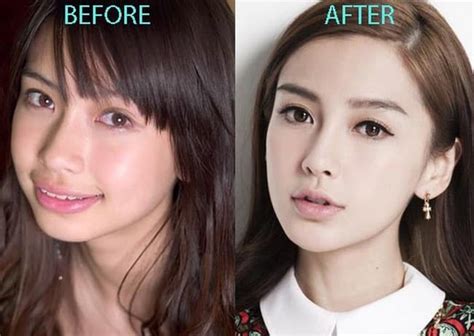 Plastic Surgery To Look Asian Before After Celebrity Plastic Surgery