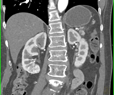 Incidental Clear Cell Renal Cell Carcinoma Rcc Lower Pole Right