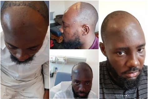 Nigerian Man Shares His Testimony After Devastating Ordeal With Brain Tumour Paralysis