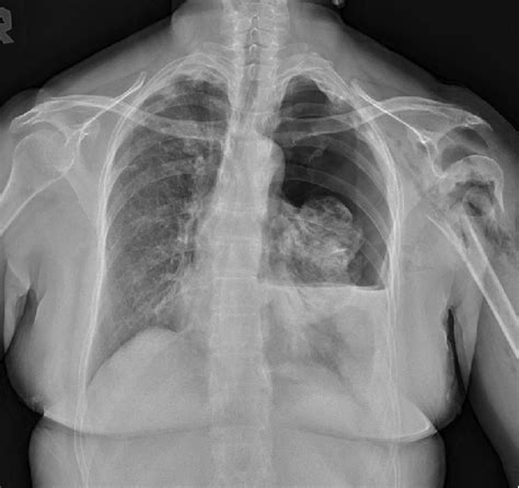 X Ray Revealing Both Fractures Of The Second To Fifth Ribs Associated