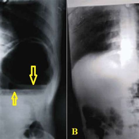 Plain Abdominal Radiography Showing Two Large Well Defined Air Fluid