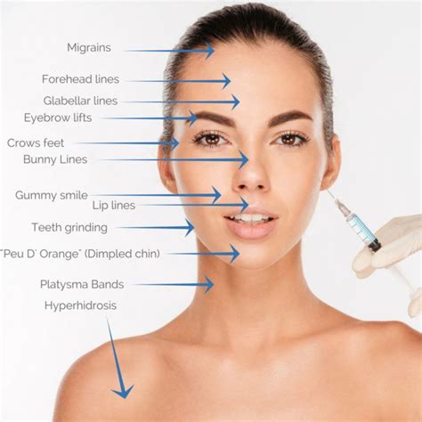 The Many Areas That Are Treatable With Botox In 2020 How To Line