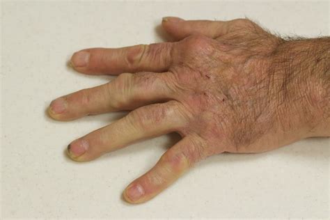 10 Symptoms Of Rheumatoid Arthritis Facty Health