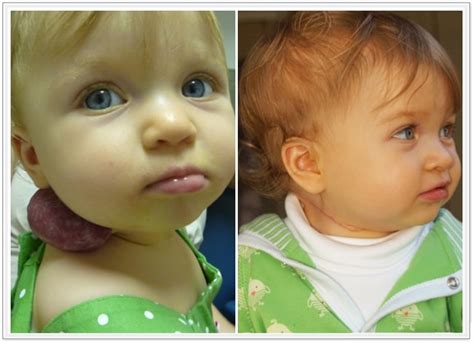 New York Hemangiomas Before And After Photos Los Angeles