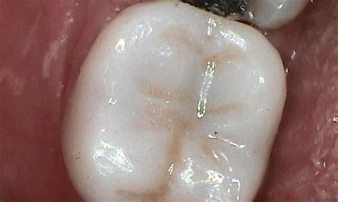 Chipped Tooth Repair Molar