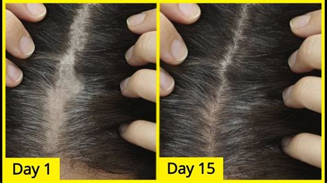 Its My Open Challenge Try This And Regrow Hair From Roots 100 Working