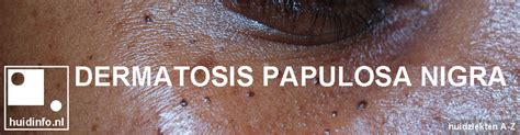 Dermatosis Papulosa Nigra Huidinfonl Dermatoloog