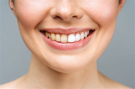 What Causes Discolored Teeth And Is There Any Way To Cure Or Prevent