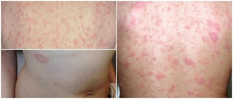 Pityriasis Rosea Signs And Symptoms When To See A Doctor Causes