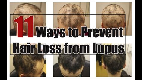 Prevent Hair Loss 11 Ways To Prevent Hair Loss From Lupus Youtube