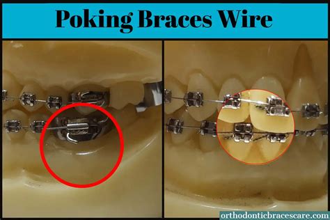 Poking Braces Wire Why This Happens How To Stop Orthodontic Braces Care