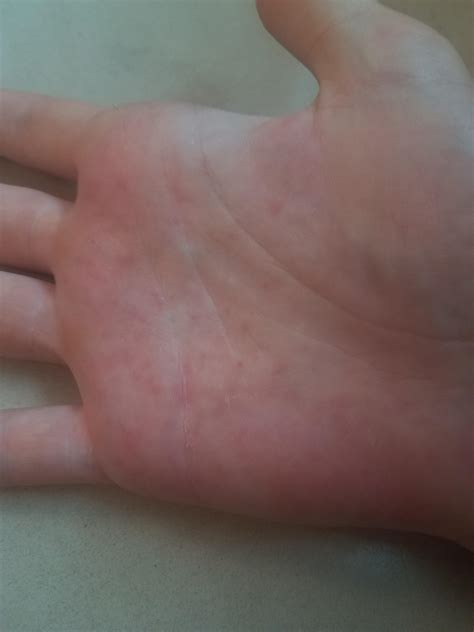 Have Tiny Itchy Bumps On My Hand Anyone Know What This Could Be