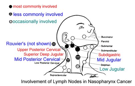 Nasopharynx Cancer