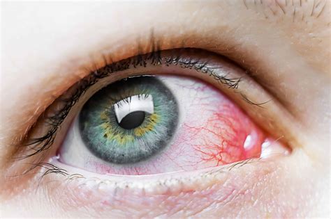 Causes Of Red Eye At Our Jenks Ok Optometry Clinic Insight Eyecare