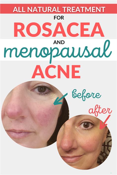 Acne And Rosacea Are A Common Occurrence In Midlife Women Thanks To
