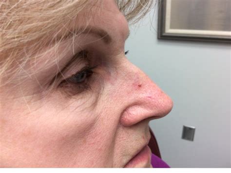Pictures Of Early Skin Cancer On Nose Cancerwalls
