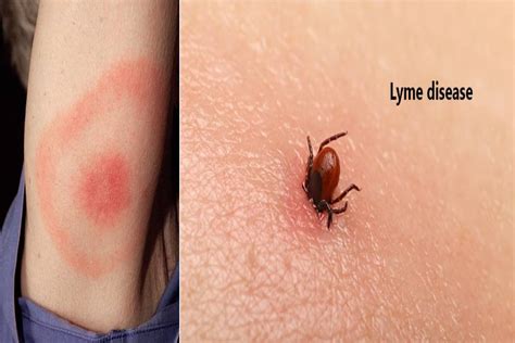What Is Lyme Disease Causes Symptoms Diagnoses And More