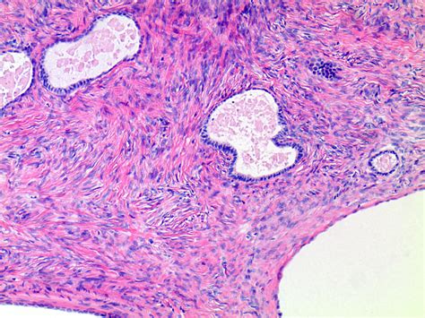 Pathology Outlines Serous Cystadenoma Adenofibroma And Surface Papilloma