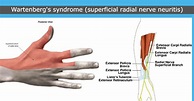 Wartenberg’s syndrome (superficial radial nerve neuritis)