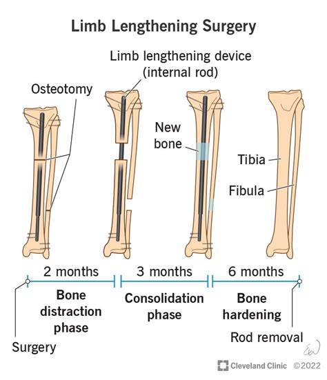Limb Lengthening Surgery Procedure Process Recovery