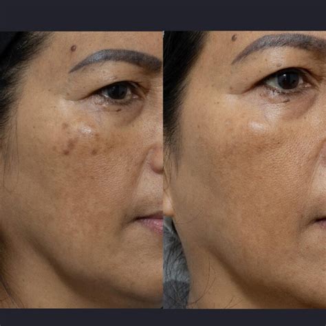 Best Ethnic Skin Rejuvenation In Australia Cutis Dermatology