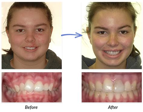 Surgery Before After 2 Delurgio Orthodontics Delurgio Orthodontics