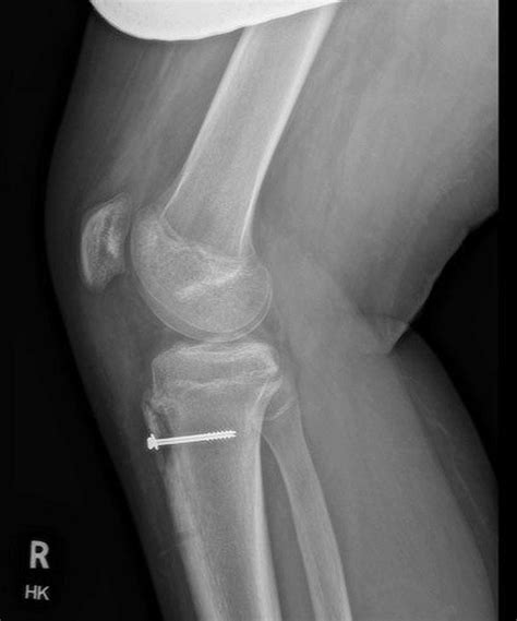 Cureus Osgood Schlatter Disease As A Possible Cause Of Tibial