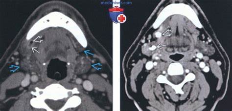 Диета при воспалении слюнной железы КТ, МРТ при добавочной слюнной железе в поднижнечелюстном пространстве КТ, МРТ при добавочной слюнной железе в поднижнечелюстном пространстве Диета при воспалении слюнной железы