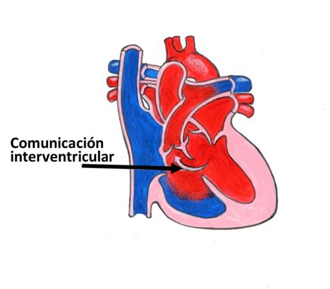 Comunicación Interventricular Cardiosaudeferrol