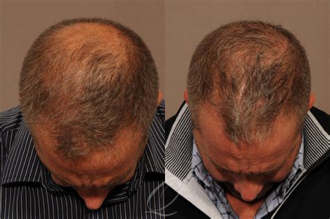 Surgical Hair Restoration In Rochester Buffalo And Syracuse Ny