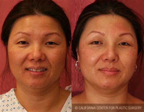 Asian Plastic Surgery Before After Job Porn