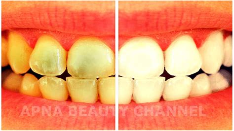 How To Clean Your Yellow Teeth Teeth Poster