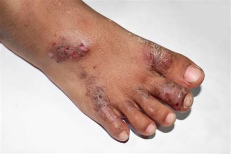10 Scabies Pustules Stock Photos Pictures And Royalty Free Images Istock