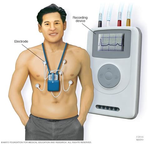 Ventricular Tachycardia Diagnosis And Treatment Mayo Clinic