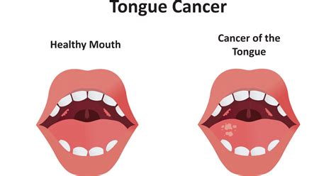 Tongue Cancer Symptoms Stages Causes Prevention And Treatment